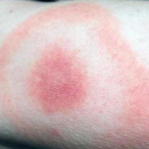 Lyme disease is often diagnosed through the presence of a target, or bulls-eye rash more than two inches in diameter, although the characteristic rash is not always present. Other symptoms include flu-like symptoms, a stiff neck, chills, fever, swollen lymph nodes, headaches, and joint pain. Courtesy of LincolnHealth