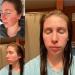 Acne Facial