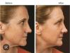 IPL Laser Treatments