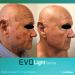 Pigmentation